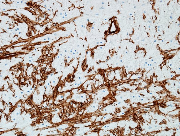 3I3 MS (Case 3) N14 Schwann remyelination Coll IV mixed Oligo-Schwann 2