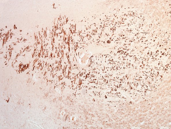 3J1 MS (Case 3) N14 Schwann remyelination Area A Po 4x