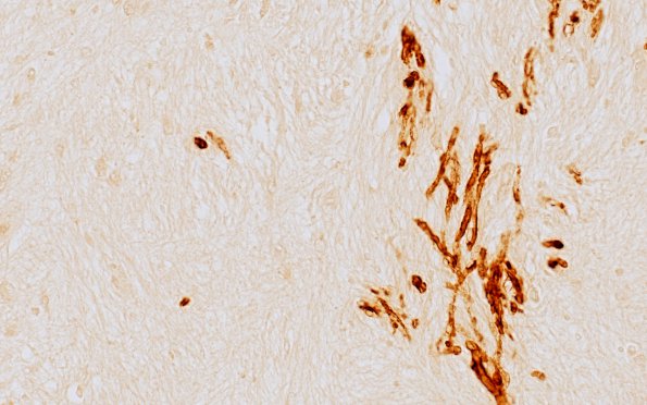 3J3 MS (Case 3) N14 Schwann remyelination Area A Po 40X