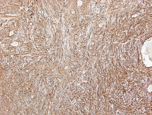 3K2 MS (Case 3) N14 Schwann remyelination Area A GFAP 10x