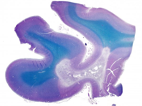 3N1 (Case 3) N15 LFB-PAS whole mount