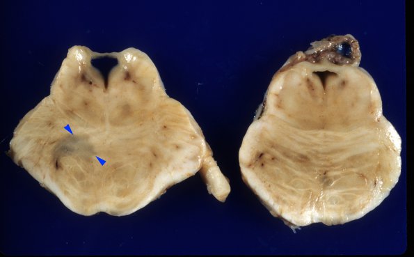 1A1 Multiple Sclerosis (Case 1) 2 copy