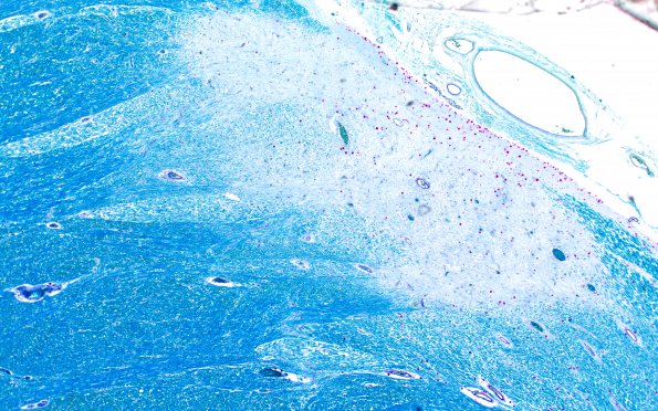 1C1 Multiple Sclerosis (Case 1) LFB-PAS pale area 4X 2 (2)