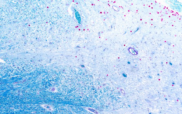 1C2 Multiple Sclerosis (Case 1) LFB-PAS pale area 10X 2