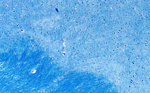 1D2 Multiple Sclerosis (Case 1) LFB-PAS shadow 1 10X