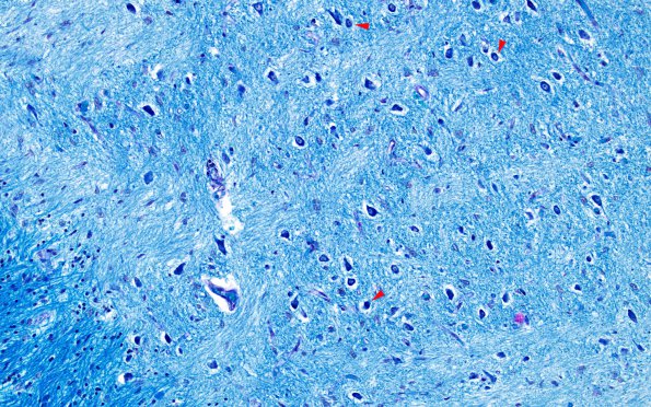 1D3 Multiple Sclerosis (Case 1) LFB-PAS shadow 1 20X copy