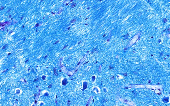 1E3 Multiple Sclerosis (Case 1) LFB-PAS shadow 2 40X