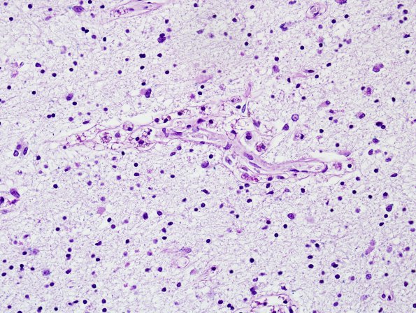 2B4 MS Shadow & Cortical Plaque (Case 2) N1 LFB-PAS 4 (2)