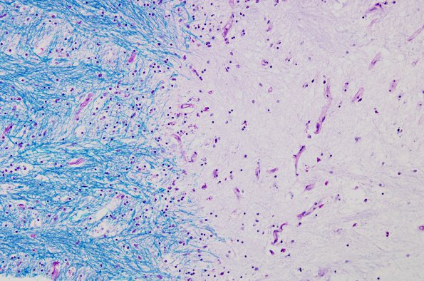 3A2 MS, Chronic inactive plaque (Case 3) LFB-PAS 20X