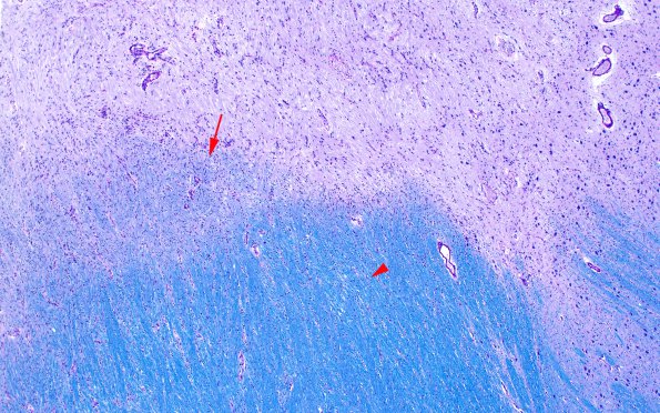 5A1 Multiple Sclerosis (Case 5) shadow plaque LFB-PAS 4X copy