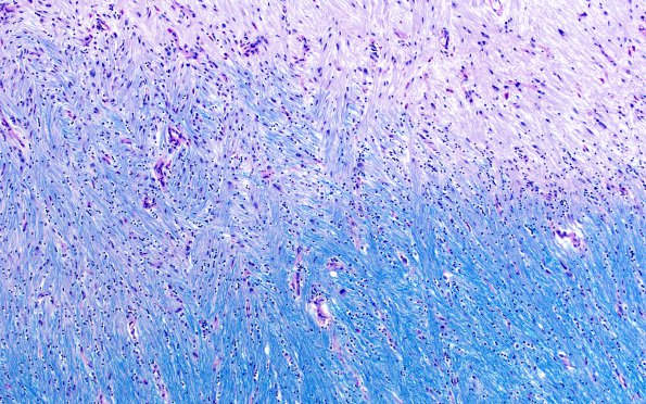 5A2 Multiple Sclerosis (Case 5) shadow plaque LFB-PAS 10X