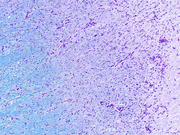 5A3 Multiple Sclerosis (Case 5) Perivent shadow plaque LFB-PAS 1