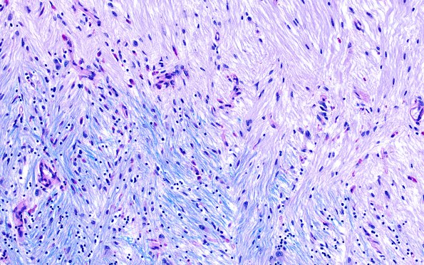 5A4 Multiple Sclerosis (Case 5) shadow plaque LFB-PAS 20X