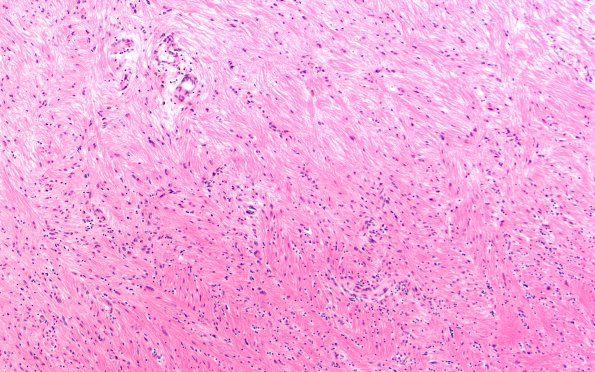 5B1 Multiple Sclerosis (Case 5) shadow plaque H&E 10X