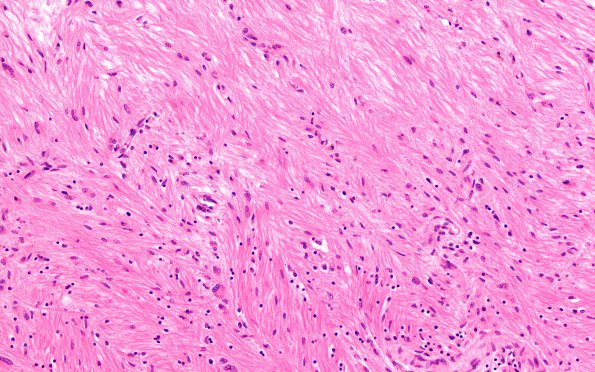 5B2 Multiple Sclerosis (Case 5) shadow plaque H&E 20X