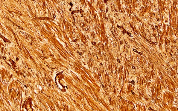 5C3 Multiple Sclerosis (Case 5) shadow plaque Biels 20X