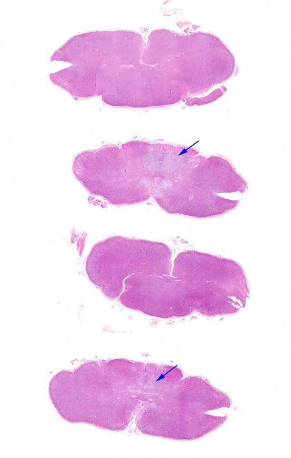 1B1 Multiple Sclerosis, 50 yr Hx (Case 1) N17 Spinal cord H&E WM copy