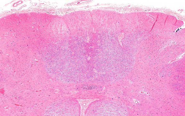 1C1 Multiple Sclerosis, 50 yr Hx (Case 1) N17 Spinal cord H&E 4X