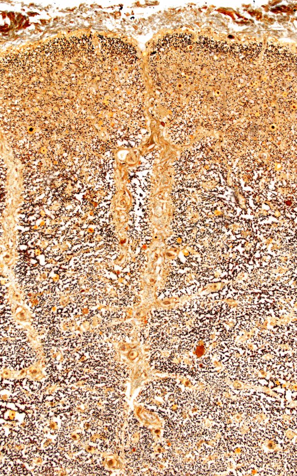 1D3 Multiple Sclerosis, 50 yr Hx (Case 1) N17 Spinal cord Biels 10X