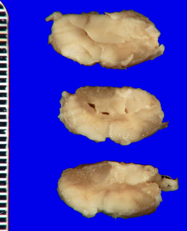 2A3 Multiple Sclerosis (Case 2) Gross 1_9A