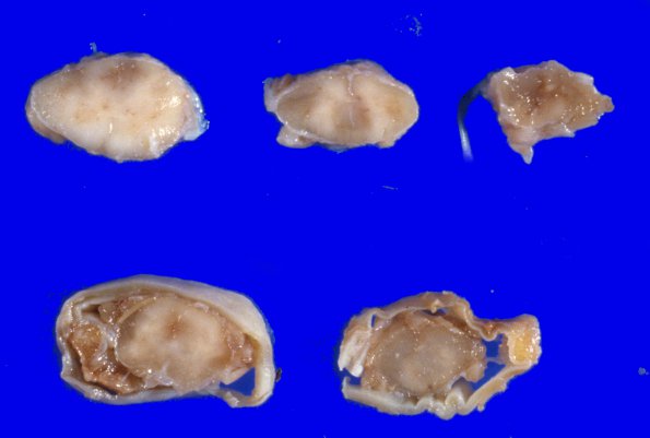 3A Multiple Sclerosis (Case 3) 3A