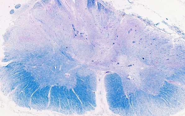 3B Multiple Sclerosis (Case 3) H LFB-PAS 2X