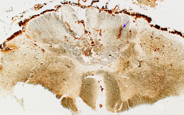 3C1 Multiple Sclerosis (Case 3) H Biels 2X copy