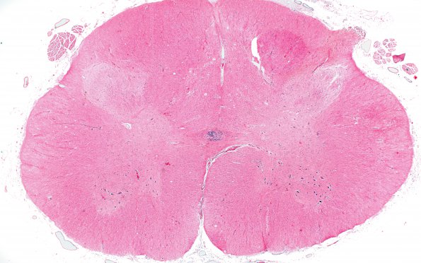 4C1 MS, spinal cord (Case 4) H&E 2X