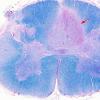 4C2 MS, spinal cord (Case 4) LFB-PAS 2X copy