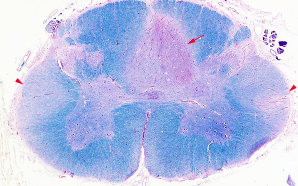 4C2 MS, spinal cord (Case 4) LFB-PAS 2X copy