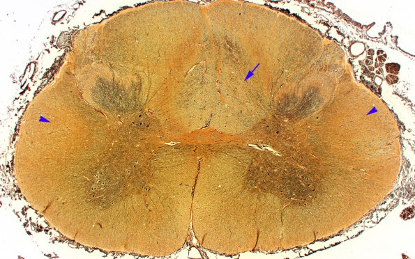 4C3 MS, spinal cord (Case 4) Bielshowsky 2X copy