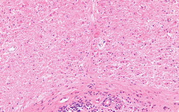 4D1 MS, spinal cord (Case 4) H&E 20X 3