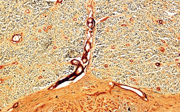 4D3 MS, spinal cord (Case 4) Bielshowsky 20X