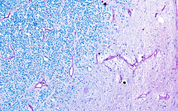 4E1 MS, spinal cord (Case 4) LFB-PAS 20X 3