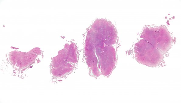 5A1 MS, chronic SC (Case 5) H&E whole mount