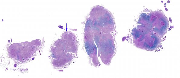 5A2 MS, chronic SC (Case 5) LFB-PAS whole mount 2 copy