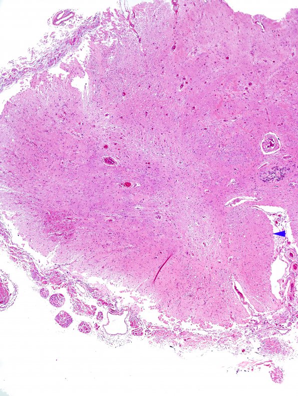 5B1 MS, chronic SC (Case 5) H&E 4x copy