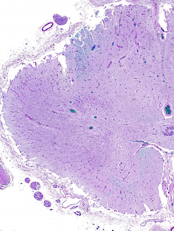 5B2 MS, chronic SC (Case 5) LFB-PAS 4x