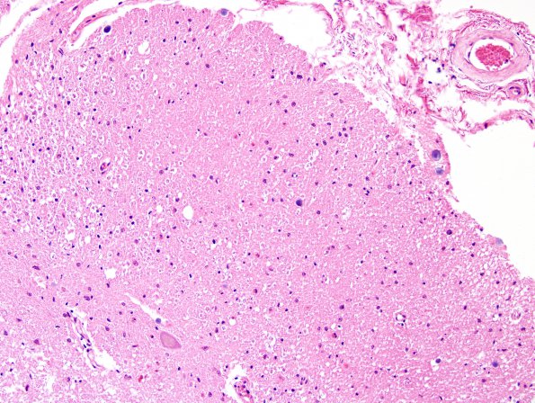 5C1 MS, chronic SC (Case 5) area A H&E 20X