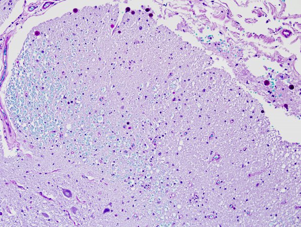 5C2 MS, chronic SC (Case 5) area A LFB-PAS 20X