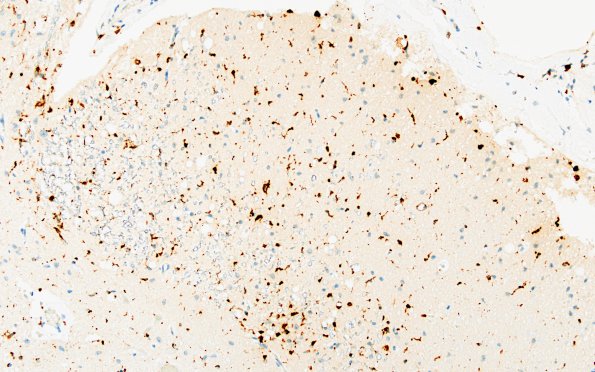 5C4 MS, chronic SC (Case 5) area A CD68 20X