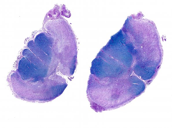 6A2 MS, spinal cord, inactive (Case 6) LFB-PAS WM