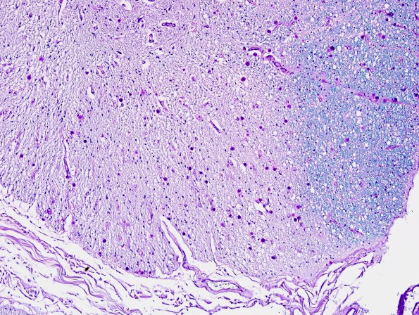 6B1 MS, spinal cord, inactive (Case 6) LFB-PAS 10X