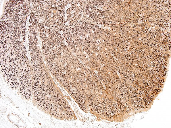 6B2 MS, spinal cord, inactive (Case 6) NF 10X 1