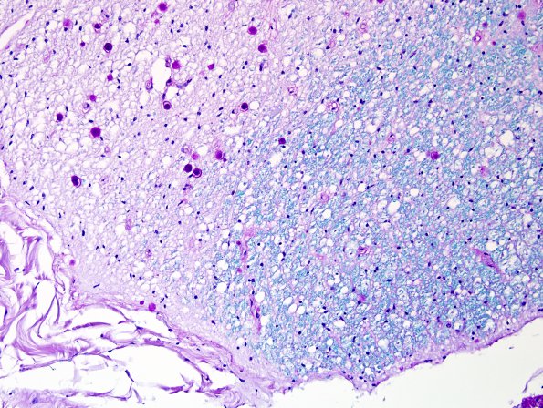 6B3 MS, spinal cord, inactive (Case 6) LFB-PAS 20X