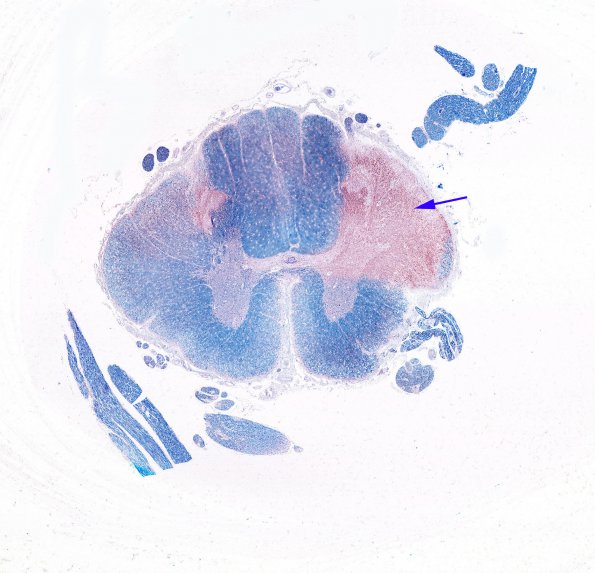 7A1 Multiple Sclerosis (Case 7) LFB- & P-NFH