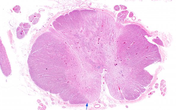 8B1 Multiple Sclerosis (Case 8) H&E 2X copy