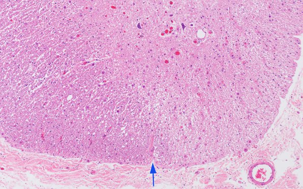 8B2 Multiple Sclerosis (Case 8) H&E 10X copy