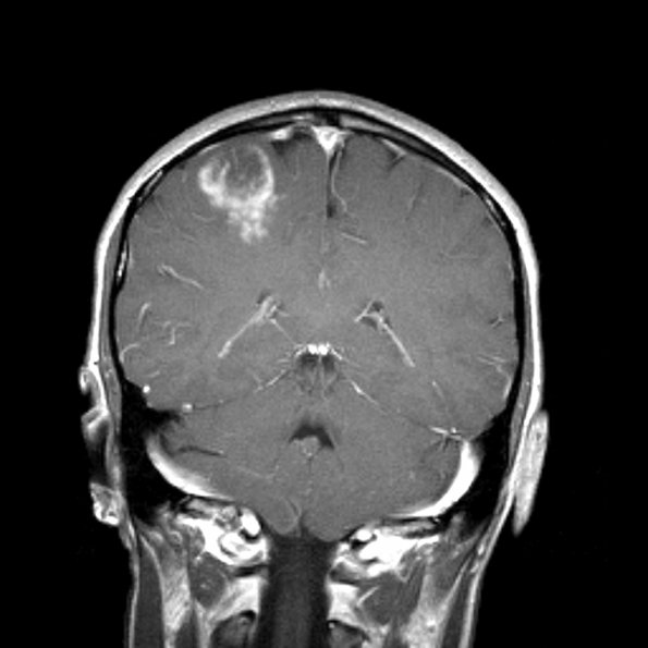 1A1 Demyelination, active MRI-1 (Case 1)_755 T1 with contrast