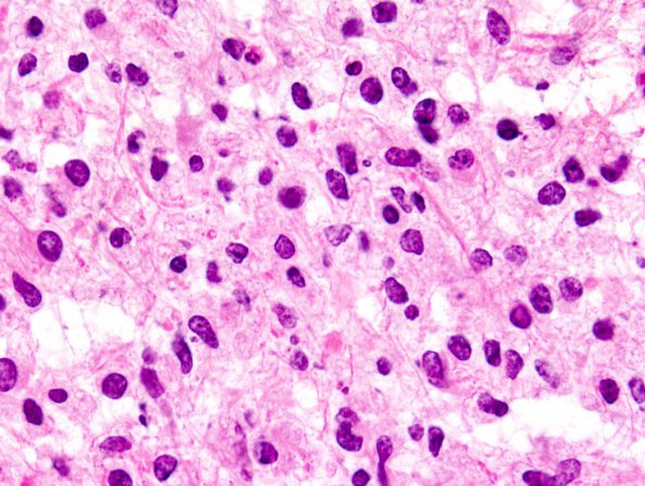 1B4 Inflammatory Demyelination (Case 1) FS 5